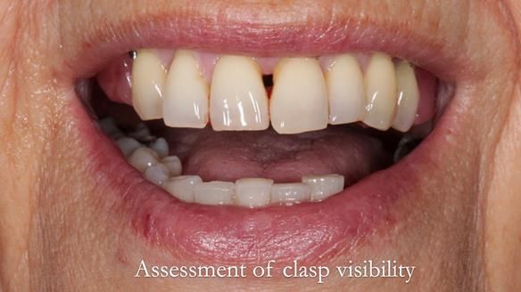 Newsletter 56 showing the making and fitting of a bilateral free end saddle upper removable partial denture (RPD) for patient with pemphigus
