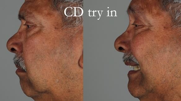 Finlay's Newsletter 62 provision of extractions and metal based complete dentures for Rafique