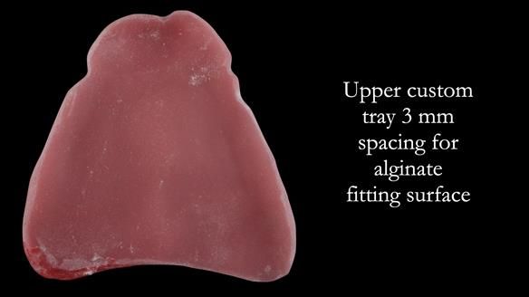 Replacing Madeline’s Complete denture FULL PROTOCOL