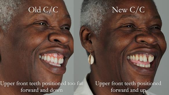 Newsletter 53 showing the making and fitting of ultra life-like dentures for Valena