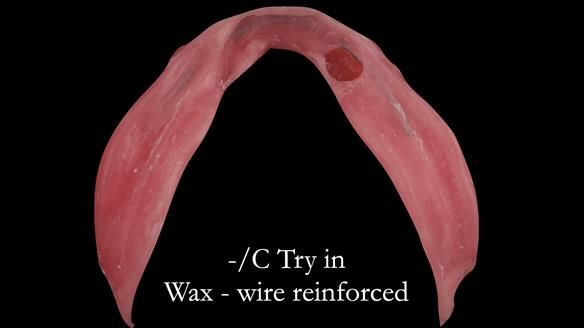 Managing poor implant positioning with complete dentures and Locator attachments - full protocol Newsletter 41