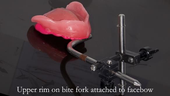 Newsletter 80 - Gordon’s dentures: the one case in 1,000 where my technique failed