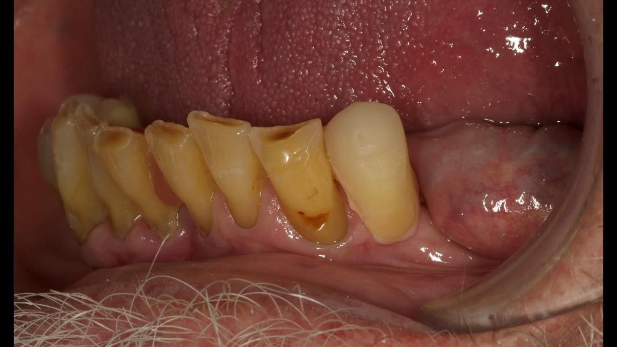 Newsletter 87 – Father Peter: A Partial Denture that needed Minor Miracle