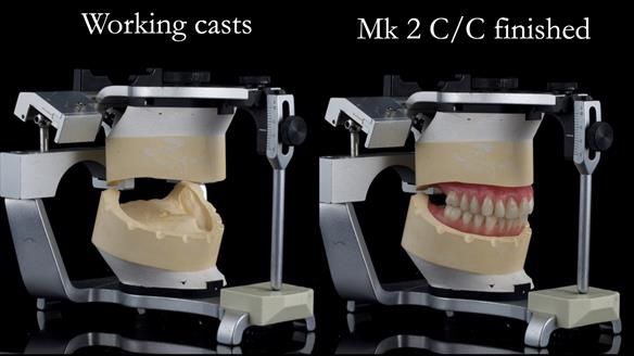 Replacing Madeline’s Complete denture FULL PROTOCOL