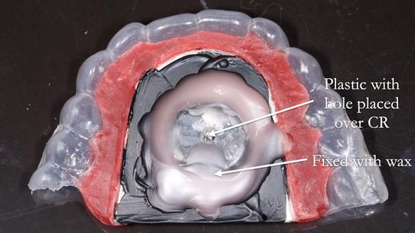 Newsletter 82 Mary - A complete upper and a one-tooth gasket denture