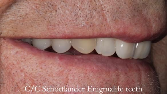 Newsletter 50 Special edition Complete Dentures FULL PROTOCOL