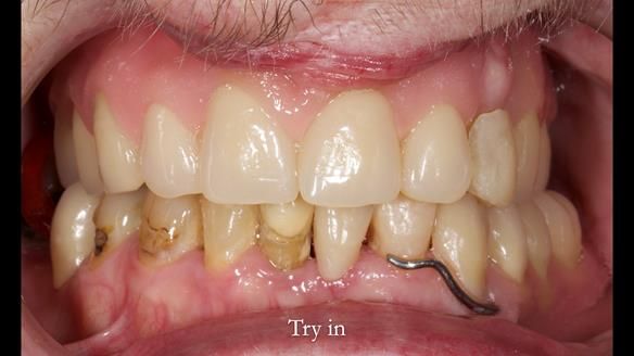 Newsletter 55 Provision of metal based partial dentures for Zephyrine with a repaired cleft lip and palate