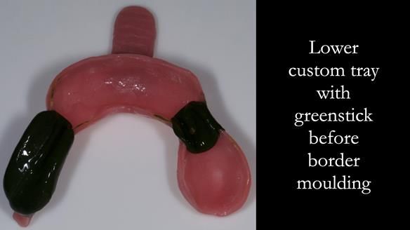 Eileen's transformation with upper and lower RPDs of Scandinavian hygienic design FULL PROTOCOL