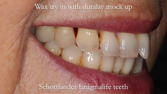 Newsletter 56 showing the making and fitting of a bilateral free end saddle upper removable partial denture (RPD) for patient with pemphigus