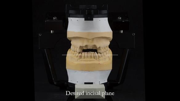 Finlay's Newsletter 63 Case study provision of metal based Scandinavian RPD - functional 10 years on