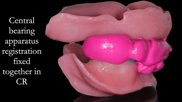 Newsletter 50 Special edition Complete Dentures FULL PROTOCOL