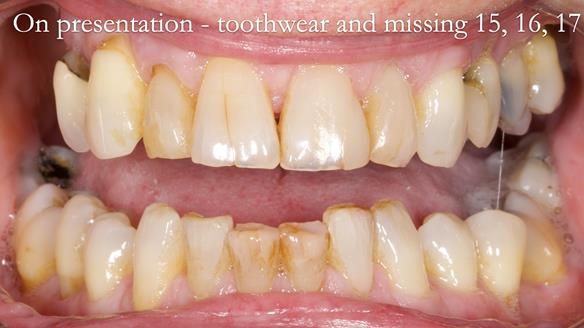 Finlay's Newsletter 64 case study - provision of a Kennedy class 2 metal based Scandinavian RPD for Ian