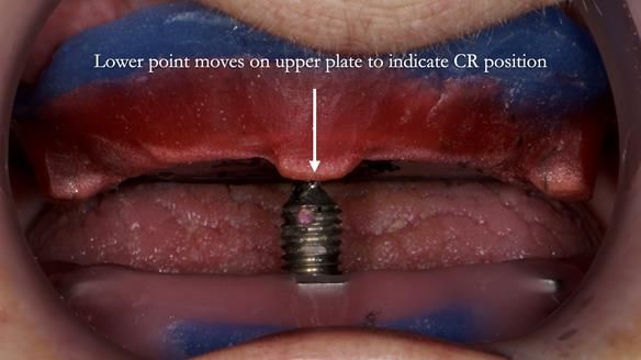 Newsletter 83: Sheila’s Complete Denture Success