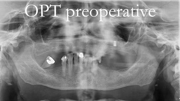 Newsletter 55 Provision of metal based partial dentures for Zephyrine with a repaired cleft lip and palate