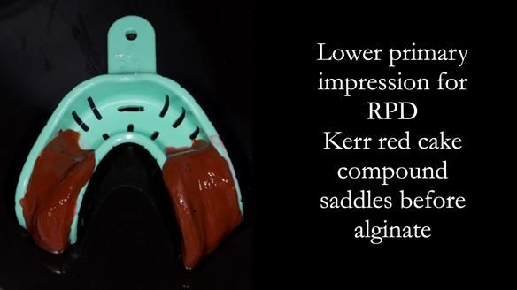 Solving Linda’s Failed “All on 4” implant bridges - full protocol Newsletter 42