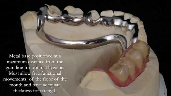Finlay's Newsletter 61 provision of a lower unilateral free end saddle metal based partial denture for Joyce