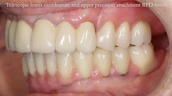 Newsletter 76: Jackie’s case – Telescopic overdenture & precision RPD (the tricky truth!)