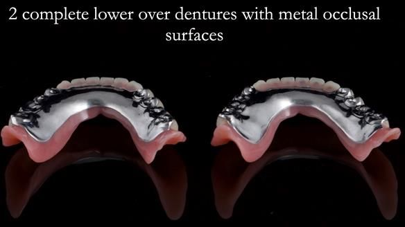 Newsletter 44 - extreme removable prosthodontics – engineering a super-strong and ultra-thin over denture