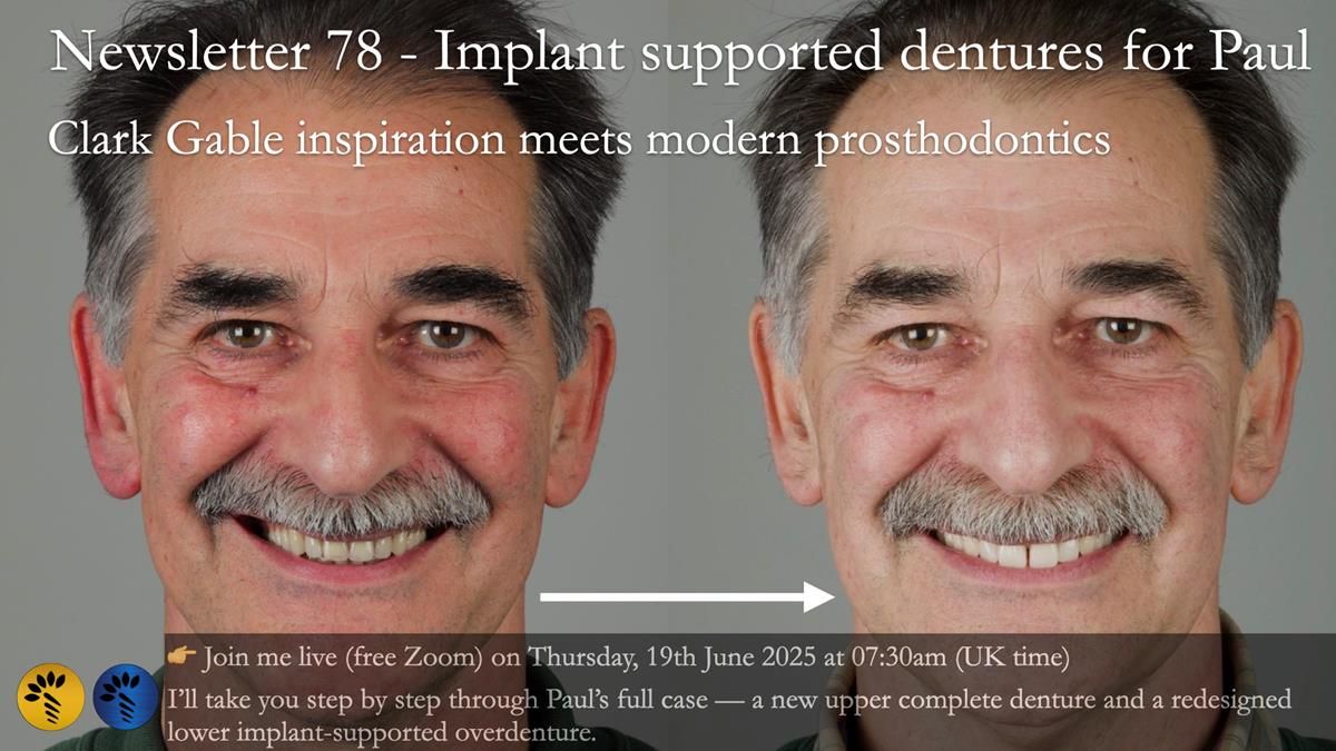 Newsletter 78: What do Clark Gable and a Locator® overdenture have in common?