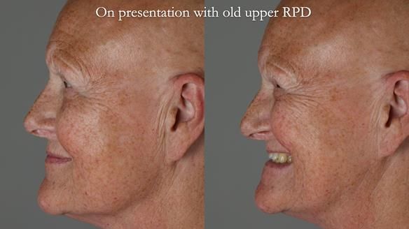 Newsletter 81 - Pam’s Story — how a partial denture changed her life (+ live walkthrough this Thursday)