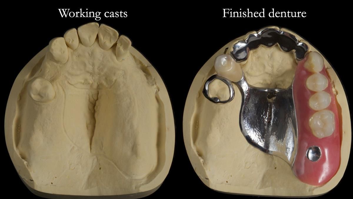 Newsletter 89 – Simon: A Challenging Kennedy Class II Division 1 Upper CoCr Partial Denture with a High Smile Line