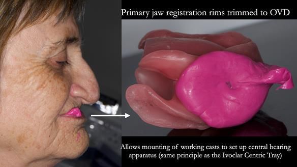 Newsletter 83: Sheila’s Complete Denture Success