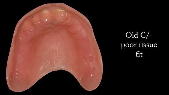 Complete denture Class II div 2 deep overbite Newsletter 39