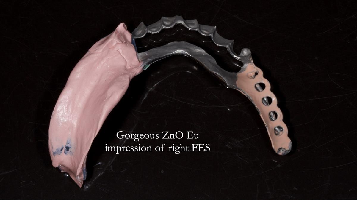 Newsletter 87 – Father Peter: A Partial Denture that needed Minor Miracle