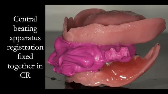 Newsletter 75: Marion’s case - Step-by-step complete denture workflow