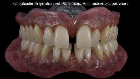 Newsletter 53 showing the making and fitting of ultra life-like dentures for Valena