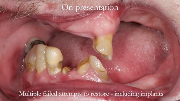 Newsletter 55 Provision of metal based partial dentures for Zephyrine with a repaired cleft lip and palate
