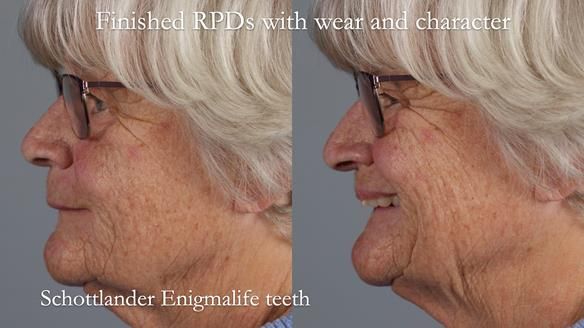 Eileen's transformation with upper and lower RPDs of Scandinavian hygienic design FULL PROTOCOL