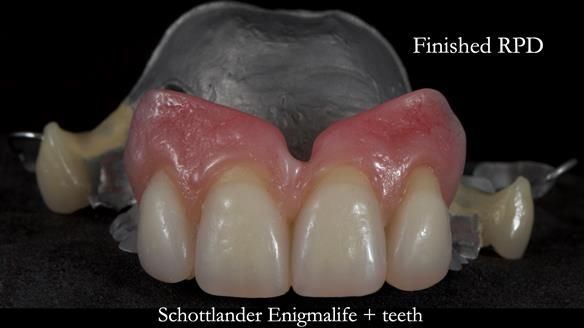 Newsletter 81 - Pam’s Story — how a partial denture changed her life (+ live walkthrough this Thursday)