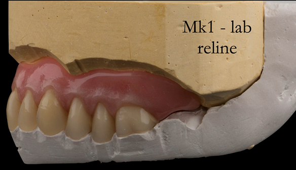 Figure 53 Reline cast and relined denture. The occlusal key in white plaster maintains the vertical dimension
