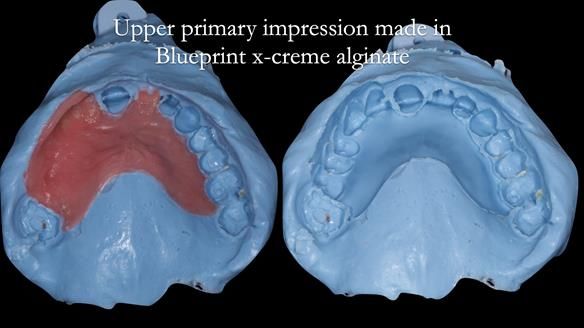 Newsletter 44 - extreme removable prosthodontics – engineering a super-strong and ultra-thin over denture