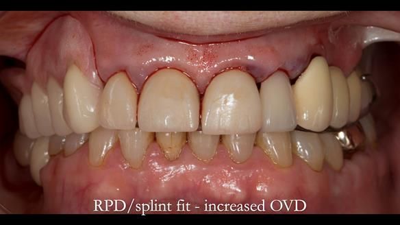 Newsletter 51 Managing Anne’s failing dentition with distal extension base RPD/Splint FULL PROTOCOL