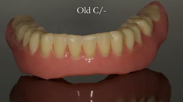 Complete denture Class II div 2 deep overbite Newsletter 39