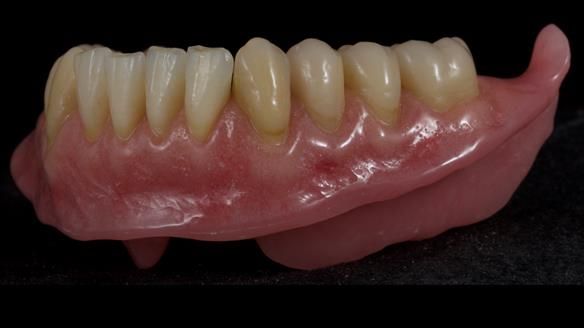 Newsletter 80 - Gordon’s dentures: the one case in 1,000 where my technique failed