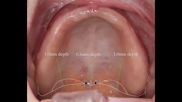 Newsletter 80 - Gordon’s dentures: the one case in 1,000 where my technique failed