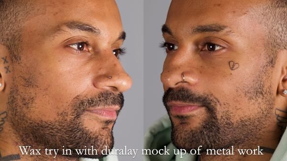 Upper metal base partial denture/occlusal stabilisation splint/obturator - full protocol