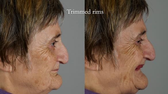 Newsletter 83: Sheila’s Complete Denture Success