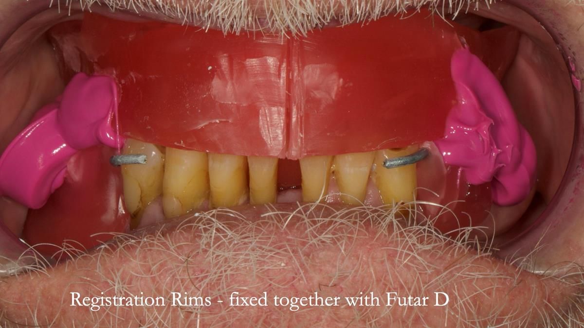 Newsletter 87 – Father Peter: A Partial Denture that needed Minor Miracle