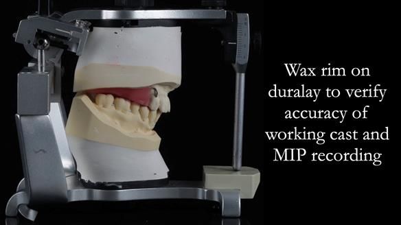Newsletter 56 showing the making and fitting of a bilateral free end saddle upper removable partial denture (RPD) for patient with pemphigus