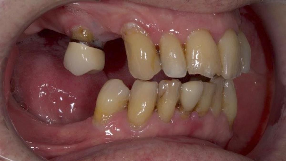 Newsletter 89 – Simon: A Challenging Kennedy Class II Division 1 Upper CoCr Partial Denture with a High Smile Line