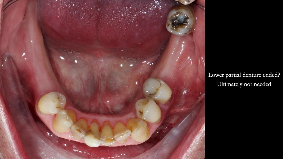 Newsletter 89 – Simon: A Challenging Kennedy Class II Division 1 Upper CoCr Partial Denture with a High Smile Line