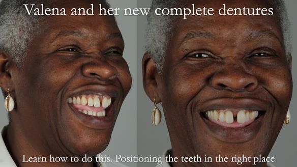 Finlay's Newsletter 59 Ultra hard partial dentures made for Gill