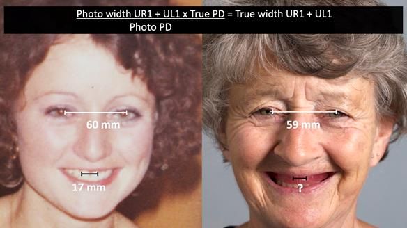 Solving Linda’s Failed “All on 4” implant bridges - full protocol Newsletter 42