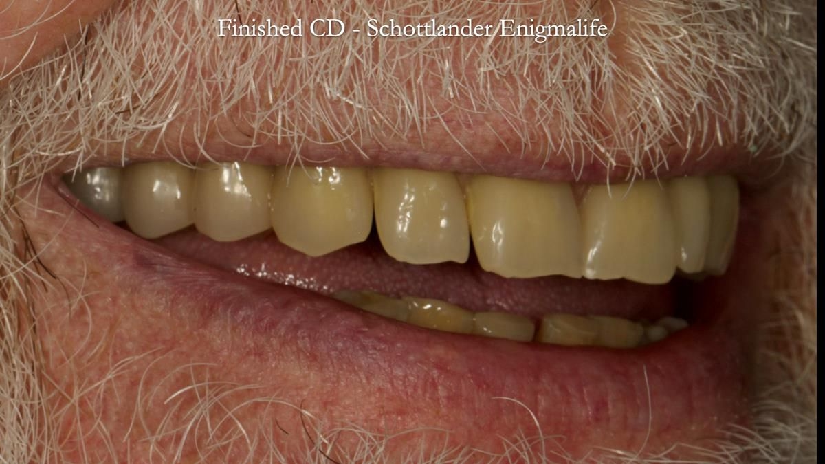 Newsletter 87 – Father Peter: A Partial Denture that needed Minor Miracle