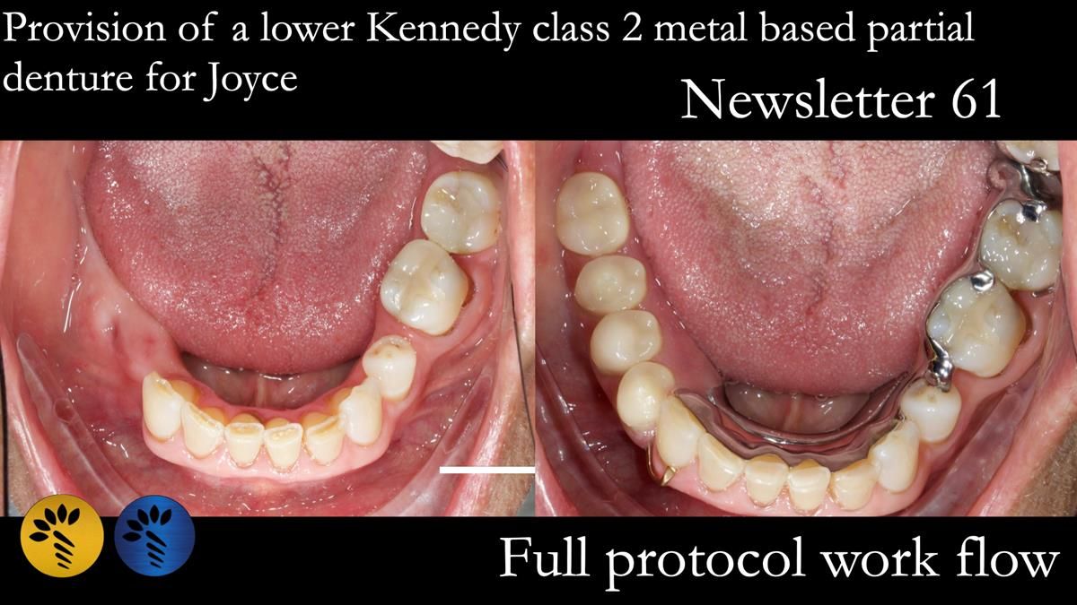 Finlay's Newsletter 61 provision of a lower unilateral free end saddle metal based partial denture for Joyce