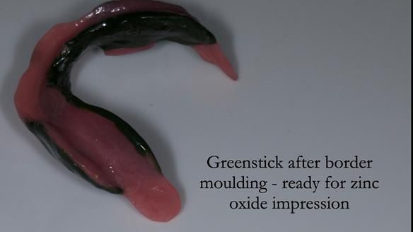 Complete denture Class II div 2 deep overbite Newsletter 39